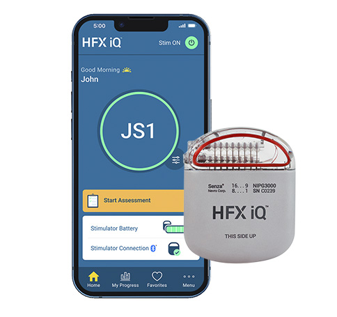 Nevro® HFX iQ™ Nevro® HFX iQ™