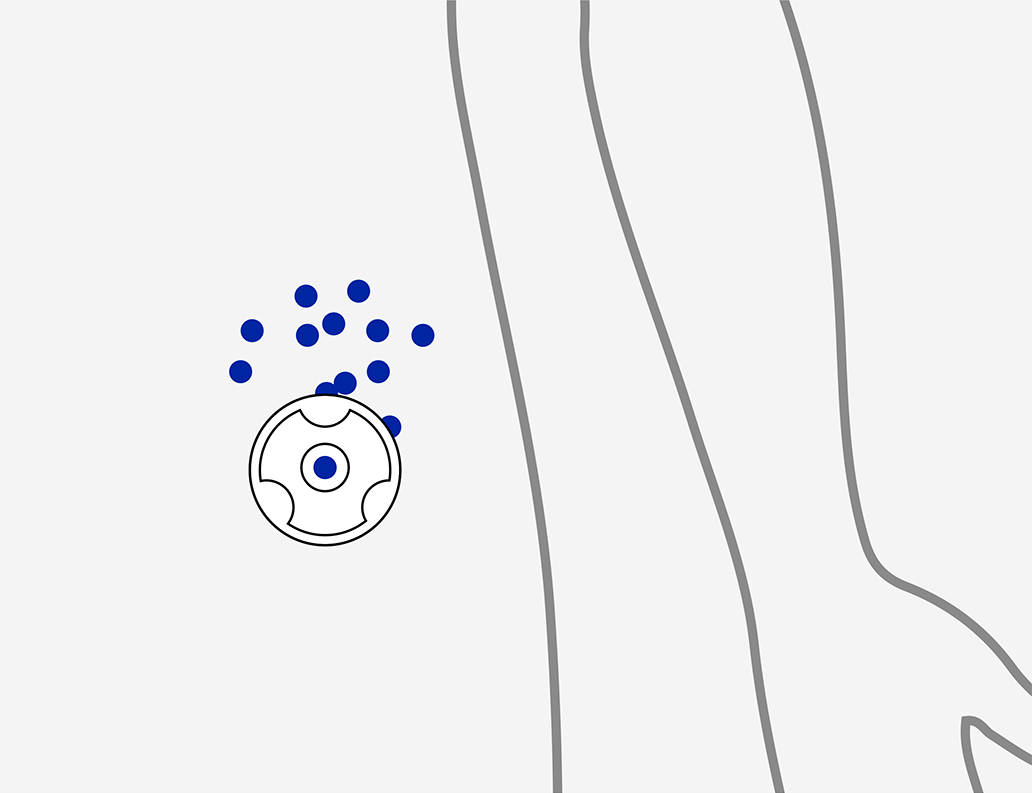 terapia multi-iniettiva tramite port