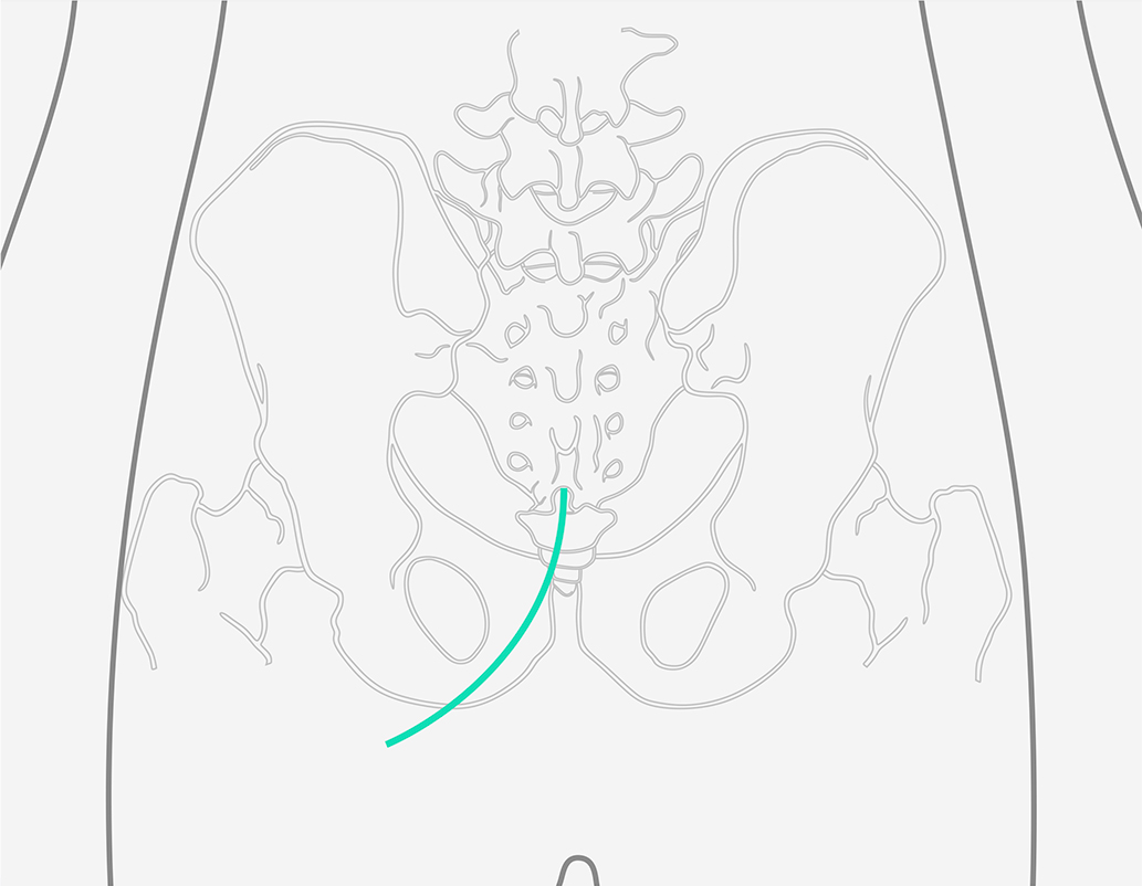 Una tecnica per ridurre il dolore causato da aderenze cicatriziali nel canale spinale.